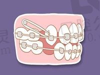 2023年牙齿矫正价格表分享:牙齿拥挤矫正6000元+开颌深覆盖8000元+地包天9000元起