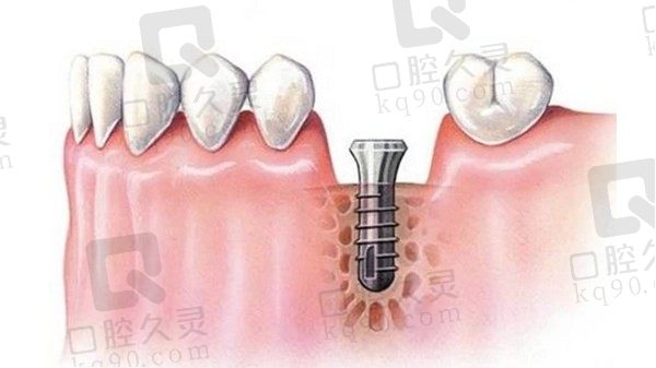 有糖尿病、高血压可以做种植牙手术吗？种植牙后注意事项有哪些？