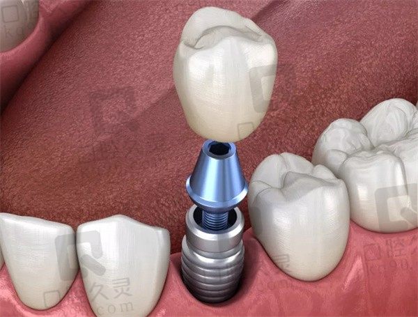 种植牙1980元一颗靠谱吗，套路还是真相戳本文你就知道