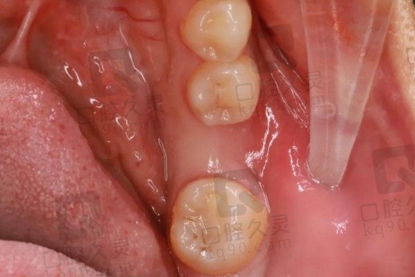 关于东莞好佰年口腔种植牙怎么样？分享本人种植牙过程和感受