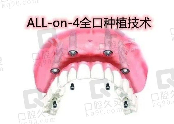 allon4和allon6区别是什么，什么情况下不能做allon4种植牙！