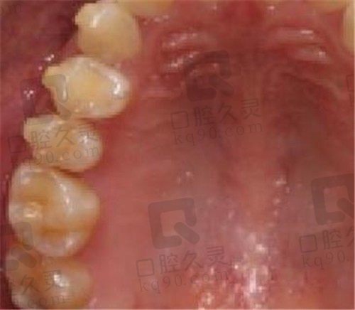 马鞍山牙百佳口腔医院种植牙一年后的感受：种植牙医院医生选择很重要！