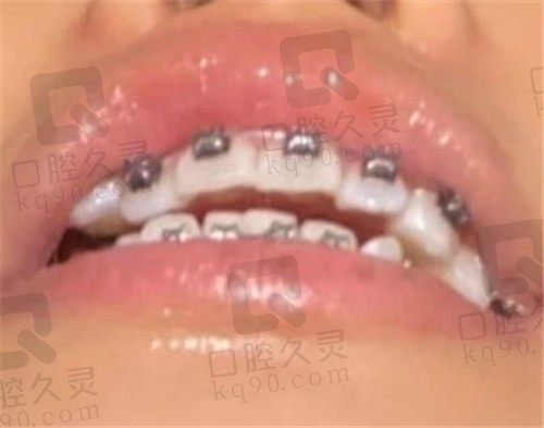 武汉市优益佳口腔矫正牙齿怎么样，看我戴牙套一年半的经历