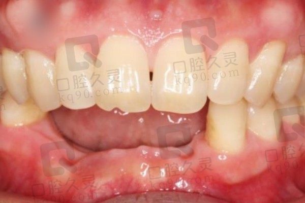 广州柏德口腔种植牙使用感受分享，医生很强且集采后价格便宜
