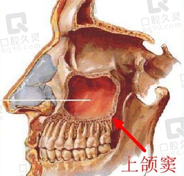 种植牙为什么要做上颌窦提升，上颌窦提升种牙术后注意事项有哪些！