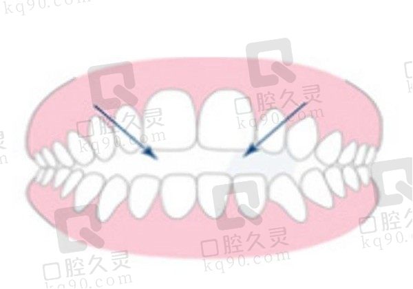 牙齿开颌矫正难度大吗，开颌有必要矫正吗