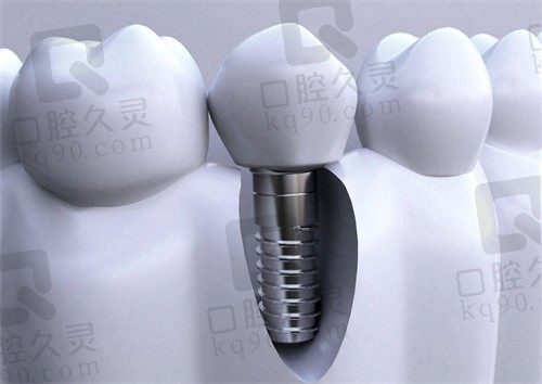 上海医大医院口腔科收费价格公开，微创种植牙仅需3999起