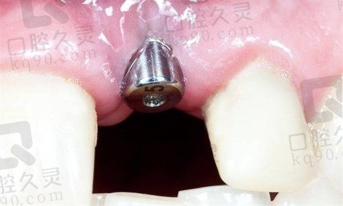 深圳爱康健口腔医院种植牙真的赞,分享我在爱康健口腔种牙全过程