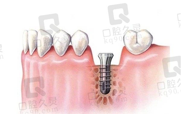 种植牙后几年牙床全烂了怎么办，种植牙的寿命一般多少年！