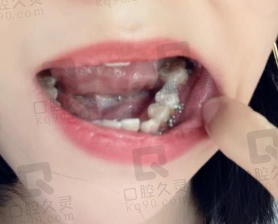 上海尤旦口腔种植牙怎么样，请看我的真实种植牙经历