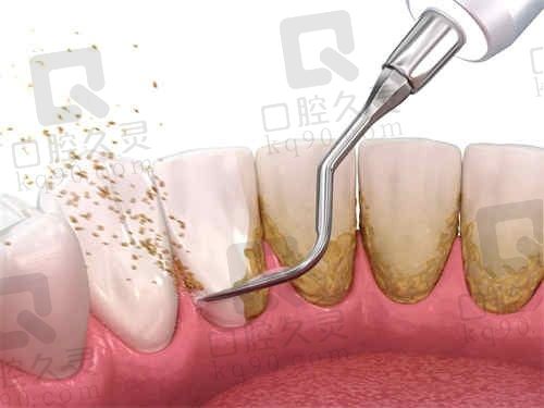 医大医院口腔洗牙对牙龈有什么益处?能有效处理牙周炎问题吗?