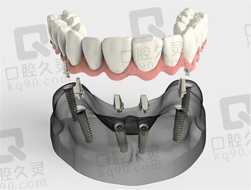 推荐南宁种植牙技术好的十家牙科医院,含种牙人气医生 