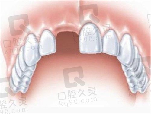 深圳格伦菲尔口腔种植牙真的靠谱,我做的韩国登腾种植牙体验感满分