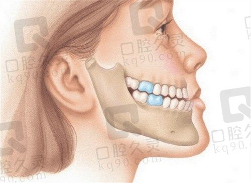 如何成功纠正严重地包天?不能错过的专家建议全分享