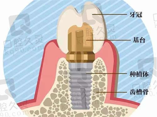 解析上海瑞伢美口腔牙齿种植价格表,韩国登腾仅需2800元/颗起！