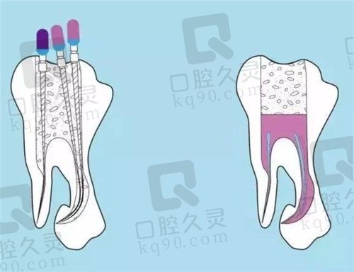 蛀牙怎么治疗最好，激光技术比根管治疗龋齿更好吗？