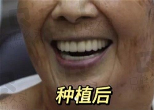  成都84岁老人在极光口腔做全口种植牙，当天就恢复如新了！