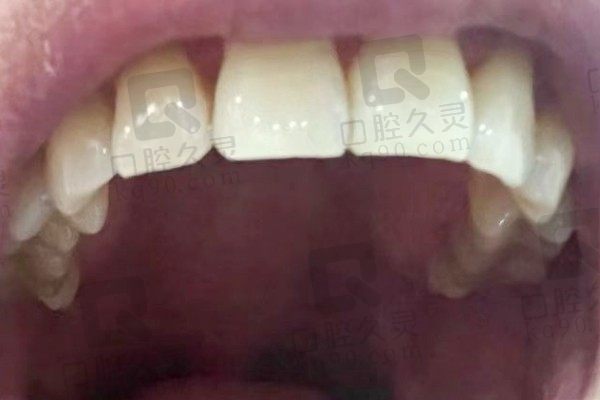 深圳格伦菲尔口腔牙齿贴面经历：天生过小牙、牙缝大一次就解决