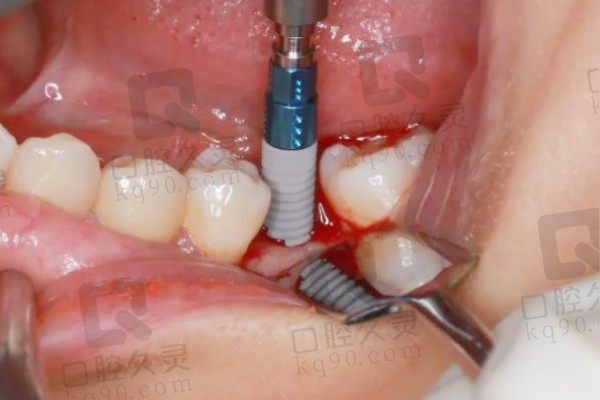太原鼎植口腔医院种牙质量如何？分享本人种植牙5年后的感受