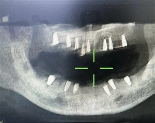 成都极光口腔55岁老人全口种牙经历分享，极光口腔种牙怎么样一目了然！