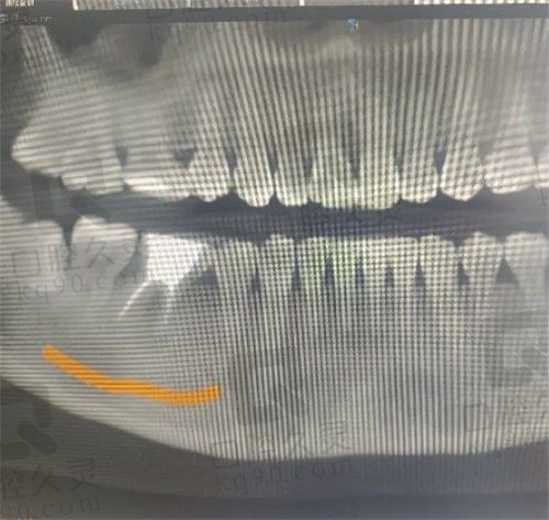 我在成都金牛极光口腔种植牙之旅分享：十几分钟就有牙了