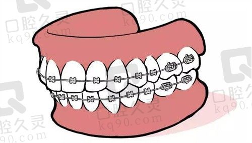 黄梅医大口腔牙齿矫正价格不贵,自锁托槽牙套矫正牙缝大仅9800起