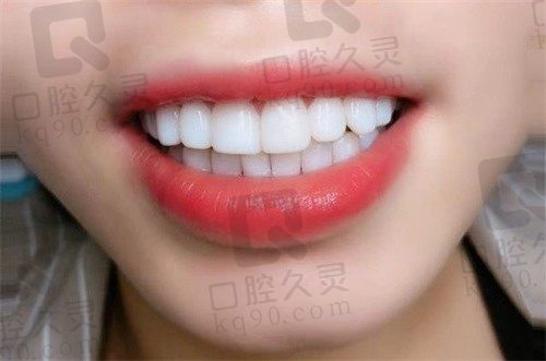 在杭州艺星口腔牙齿美白贴面花了9800,做完即刻拥有一口大白牙