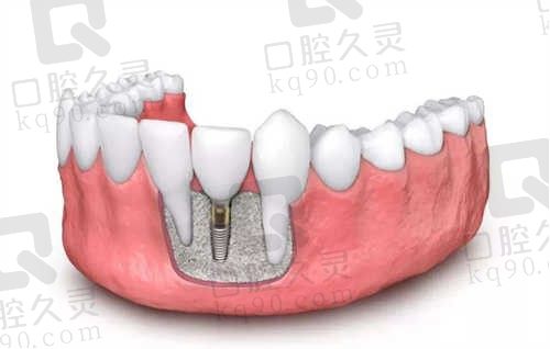 武汉德韩口腔种植牙多少钱,贵不贵?价格很优惠,较低价格1380元!
