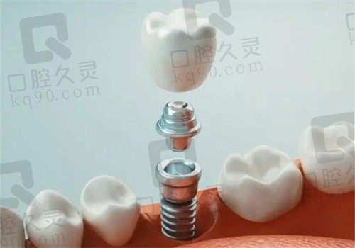 新泰美润口腔种植牙一颗多少钱?韩国登腾3980|德国贝格8700|瑞士进口11800元起