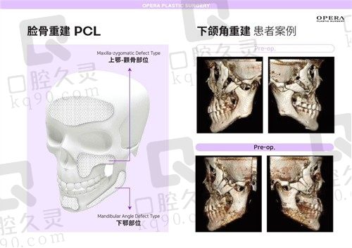 韩国欧佩拉PCL补骨技术解析,金锡汉3D打印设计贴合度好排异小！