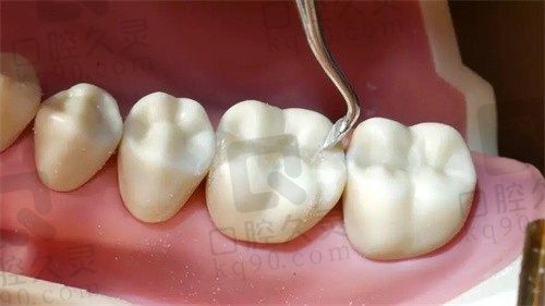 2024广安爱牙仕口腔项目价格公开了,洗牙+补牙+种植牙价格挺便宜