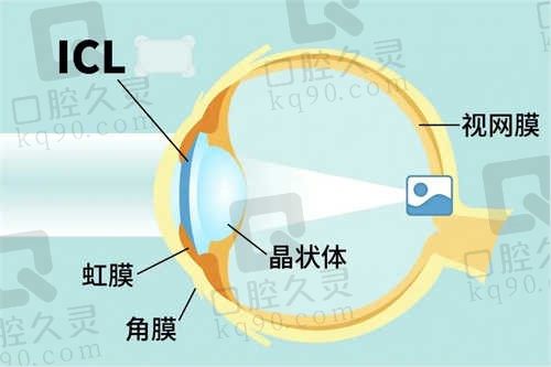 昆明华厦眼科医院ICL晶体植入手术贵不贵?ICL晶体植入价格为28000元起,价格优惠安全性高!
