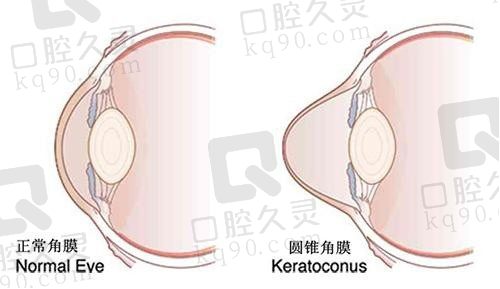 上海和平眼科医院角膜交联单眼手术价格1万元起,在线免费咨询挂号