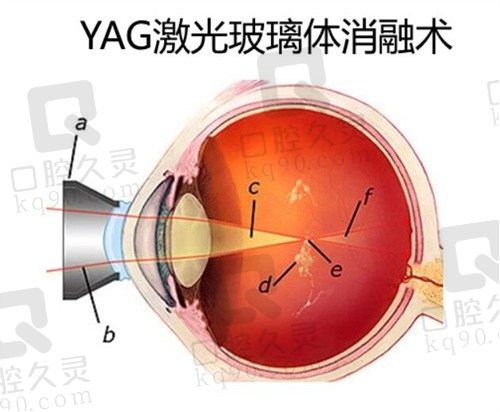 玻璃体手术时间1小时起步,风险可控半年内视力稳定!