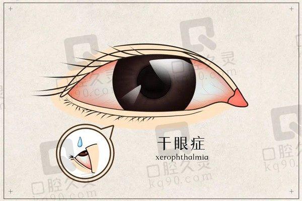 【科普】干眼症有哪些症状表现？是什么引起的又该如何治疗呢