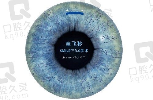 上海新视界眼科做近视矫正很牛，花费1w6做全飞秒近视手术很值得