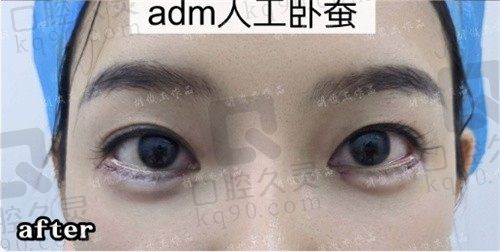 ADM人工真皮卧蚕多少钱?分享2024年ADM卧蚕的真实价格及过程