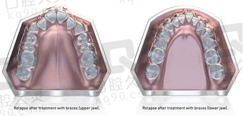 深圳牙齿矫正哪家医院比较好?深圳慈恩 同步 爱康健做牙齿矫正都不错