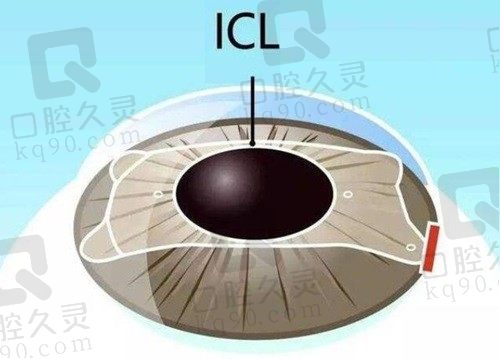 预约挂号上海医大眼科医院后，才晓得医大眼科做ICL近视矫正术超赞