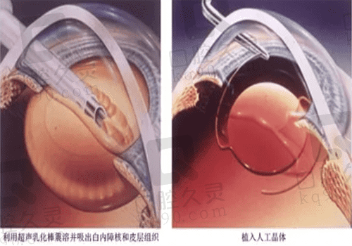 冷超声乳化与超声乳化有啥区别?从手术原理|费用|风险等来了解