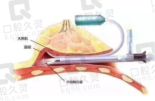 谢卫国医生假体隆胸怎么样？下皱襞/乳晕/腋下隆胸术式令人啧啧赞叹