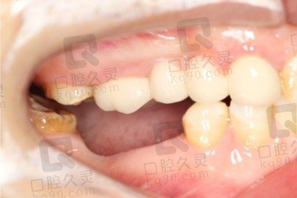 长沙中诺口腔医院种牙体验分享：后磨牙缺三颗种两颗技术超好