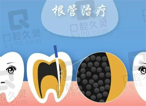 杭州根管治疗哪家好?排名前三的这几家不仅价格便宜还能用医保