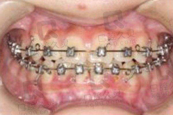重庆牙博士口腔正畸技术超赞！乱牙“改斜归正”仅用时一年半
