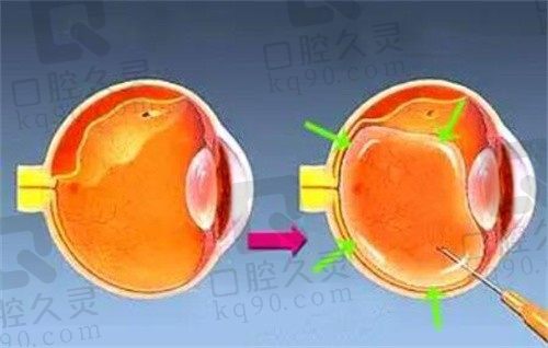 北京熙仁眼科医院眼底病治疗记录,感恩马志中帮我修复视网膜脱落！