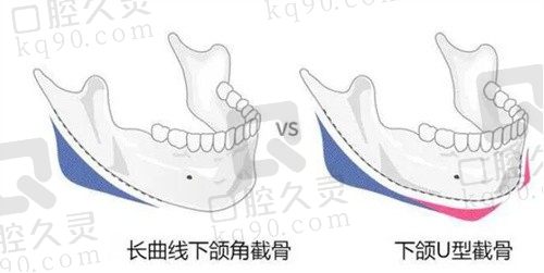 北京联合丽格何照华磨骨特色:张力带固定颧骨颧弓/长曲线截骨术效果自然出众