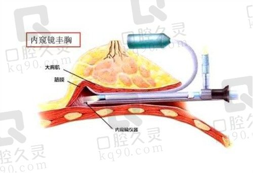 韩国欧佩拉整形隆胸技术成熟,术后恢复快且手感自然50000起!