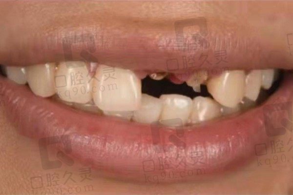 长沙中诺口腔医院种植牙正规可靠！父亲两颗门牙即拔即种很省心