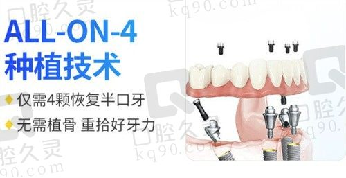 福州维乐口腔半口种植牙多少钱?all-on-4半口种植只要4.5W+