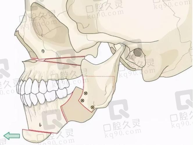 下颌骨歪斜怎么矫正？戴牙套正畸VS正颌手术优缺点对比